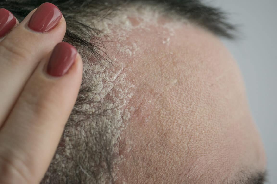 14 rimedi naturali per sbarazzarsi della psoriasi del cuoio capelluto